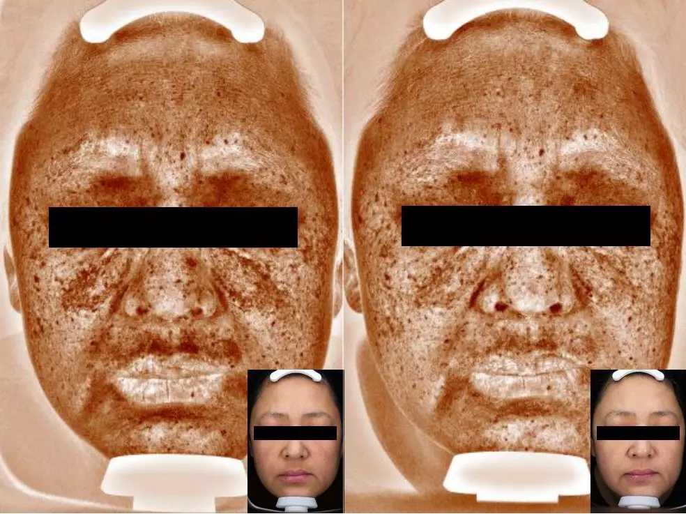 visia皮肤检测棕色斑图片
