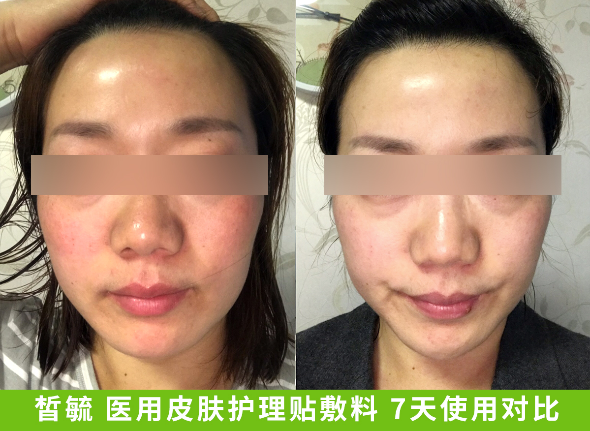 敏感肌,皮肤过敏和激素脸,你分得清吗?